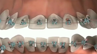 ارتودنسی نامریی چیست ؟