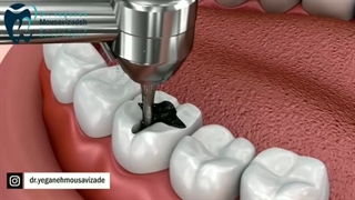 دندونم پوسیده شده چیکار کنم ؟؟