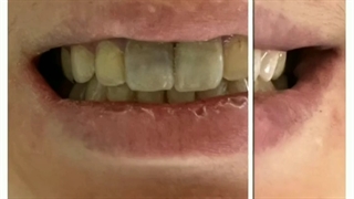 دندون های مثل برف داشته باش