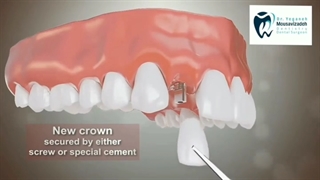 ایمپلنت دندان