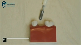 به نظر شما ایمپلنت درد داره ؟