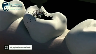 دندانم پوسیده چیکار میتونم بکنم ؟