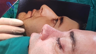 جراحی بینی مردانه