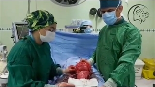 چه زمانی فیبروم ها باید برداشته شوند؟