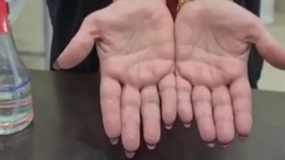 فیلم رضایت بیمار یک سال پس از جراحی سندرم تونل کارپال