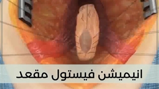 فیلم درمان فیستول مقعدی