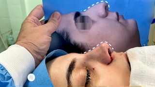 نمونه ای از جراحی بینی طبیعی بلافاصله بعد از جراحی