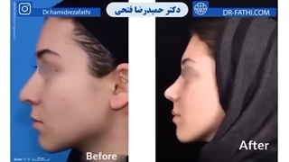 نمونه ای از جراحی رینوپلاستی برای مراجعه کننده خانم