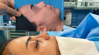 بلافاصله قبل و بعد از جراحی رینوپلاستی