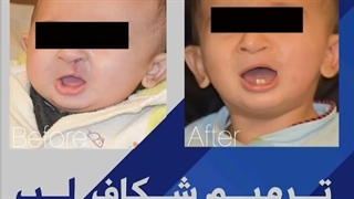 ترمیم شکاف کام ولب