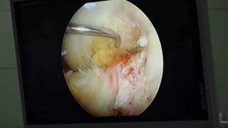 جراحی اصلاح انحراف زانو