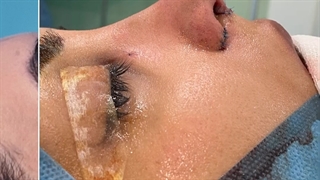 جراحی رینوپلاستی طبیعی