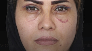 درمان افتادگی پلک در تهران-کلینیک vip تهران