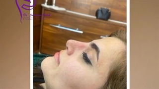 فیلم یک ماه پس از جراحی بینی