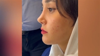 بعد از عمل بینی