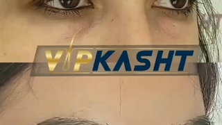 کاشت مو با جدیدترین متد روز دنیا-کلینیک vip
