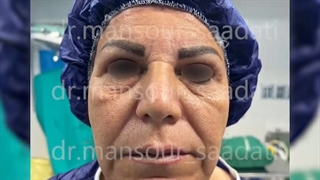 تزریق چربی به صورت پروتز دندان