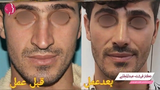 نمونه جراحی بینی مردانه