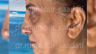 جوانسازی یا rejuvenation صورت