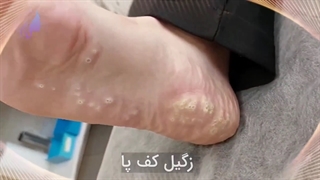 1درمان زگیل کف پا بلیچینگ