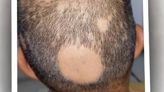 ریزش مو منطقه ای گسترده (الوپسیا اراتا)