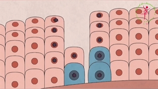 سرطان پستان یعنی چجوریه؟