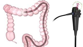 یعنی سرطان روده ست؟