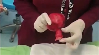 محل قرارگیری میوم رحمی