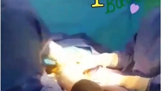 سزارین دوقلوها