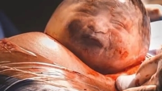 ❌کیسه امنیوتیک در طول زایمان پاره میشه ولی بعضی اوقات هم کیسه سالم و دست نخورده در طول زایمان خارج میشه