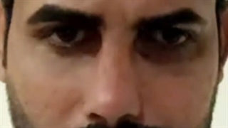 نمونه جراحی بینی آقایان