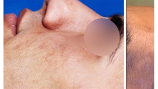 جراحی زیبایی بینی