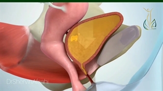 درمان دیگری برای بی اختیاری ادرار و افتادگی مثانه