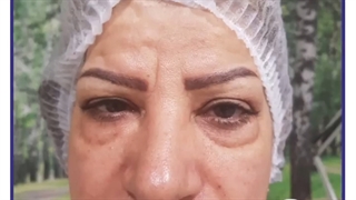 عمل جراحی پلک