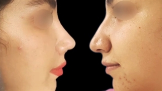 نمونه جراحی بینی توسط دکتر پریسانظرپور