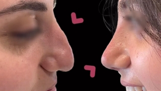 نمونه جراحی بینی