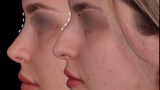 نمونه جراحی بینی