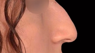 جراح بینی استخوانی