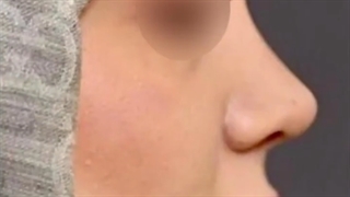 جراحی بینی بانوان