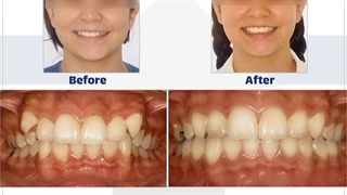 درمان ارتودنسی توسط دکتر نگار حدادی ارتودنسی