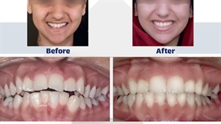نمونه کار ارتودنسی دکتر نگار حدادی کاشت ابرو