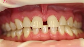 انجام بلیچینگ دندان+مزایا و معایب