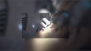 فیلم مراحل انجام لمینت دندان از "آماده سازی تا نصب"