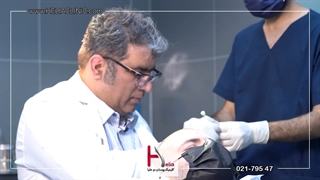 کاشت مو به روش میکروگرافت هلیا