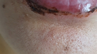 ریمو خط لب بدرنگ و پخش شده