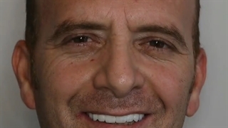 دکتر وحید دهقان : ایمپلنت فول فک بالا