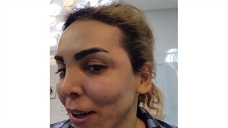 تزریق چربی به صورت