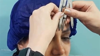 کاشت ابروی طبیعی بدون درد