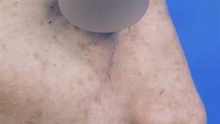 عمل بینی گوشتی