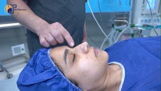 جراحی بینی نیمه فانتزی